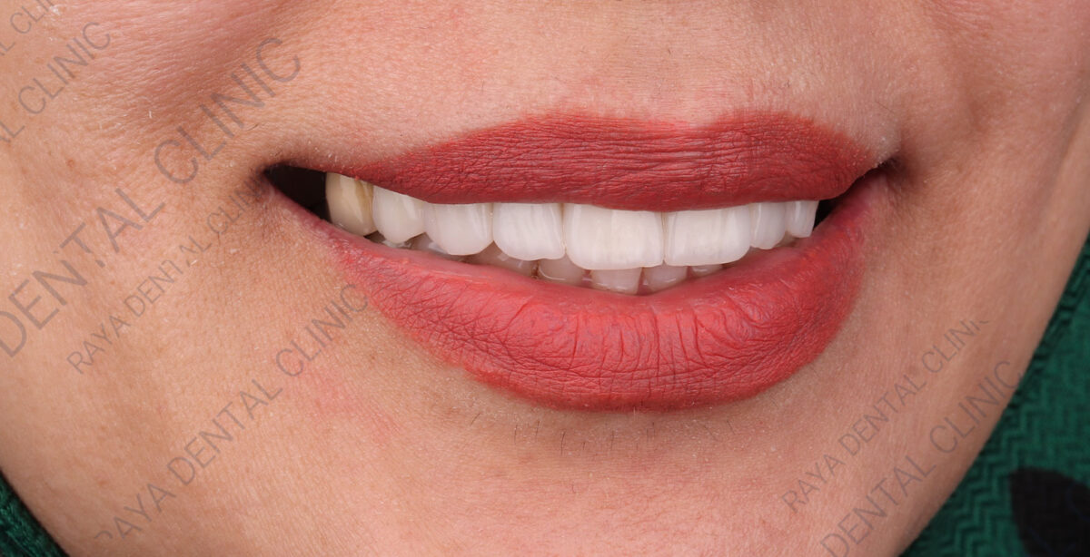 بعد از لمینت