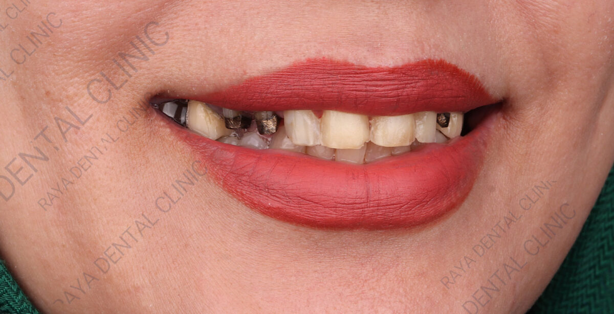 قبل از لمینت