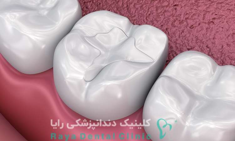 هزینه کامپوزیت دندان