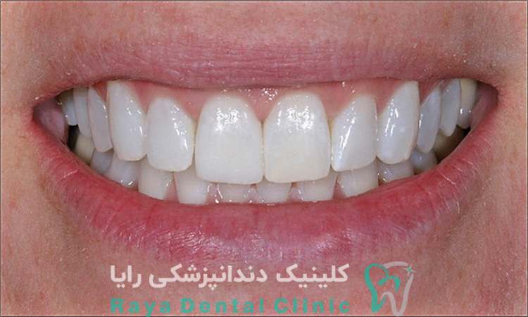 ترند جدید کامپوزیت
