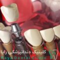 قیمت کاشت دندان