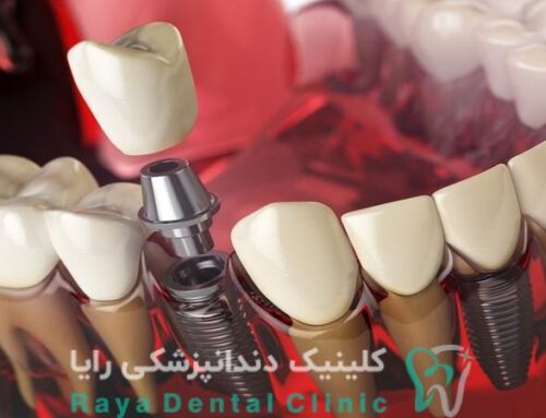 تفاوت کلینیک‌ های خصوصی و دولتی در قیمت کاشت دندان