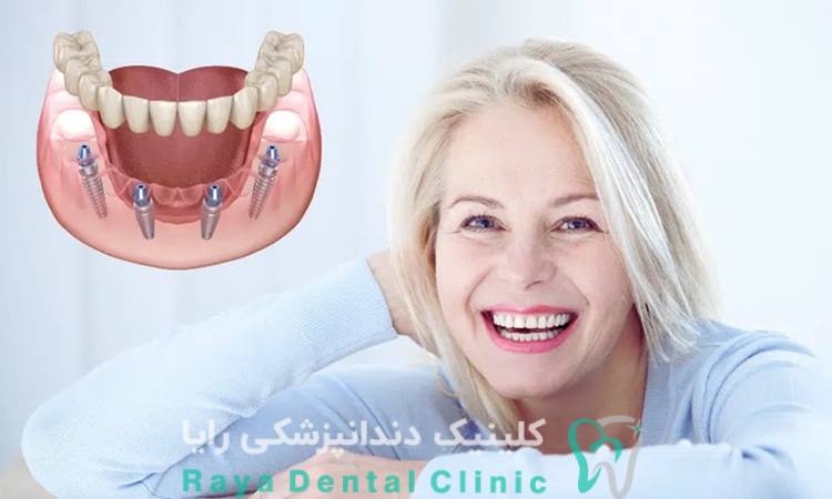 هزینه ایمپلنت