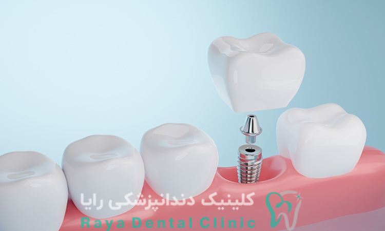 ایمپلنت دندان