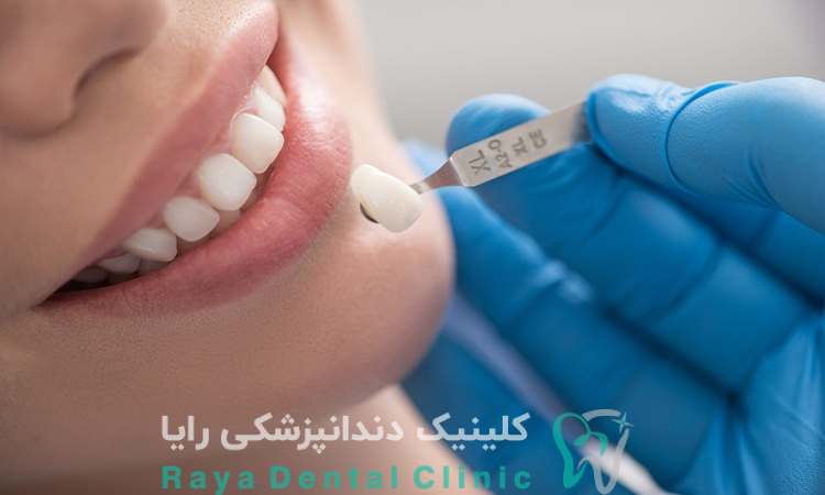 لمینیت فوری دندان