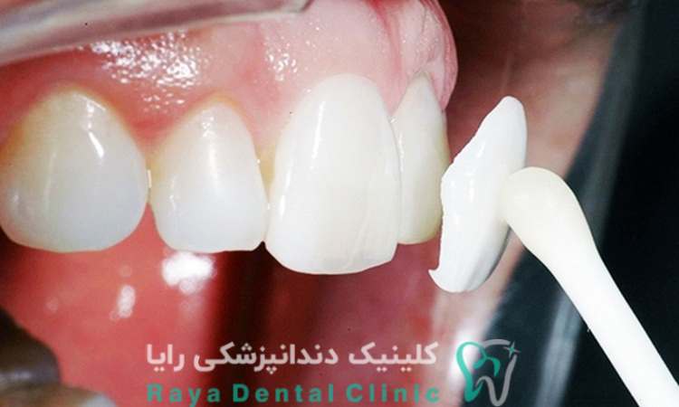 لمینیت دندان