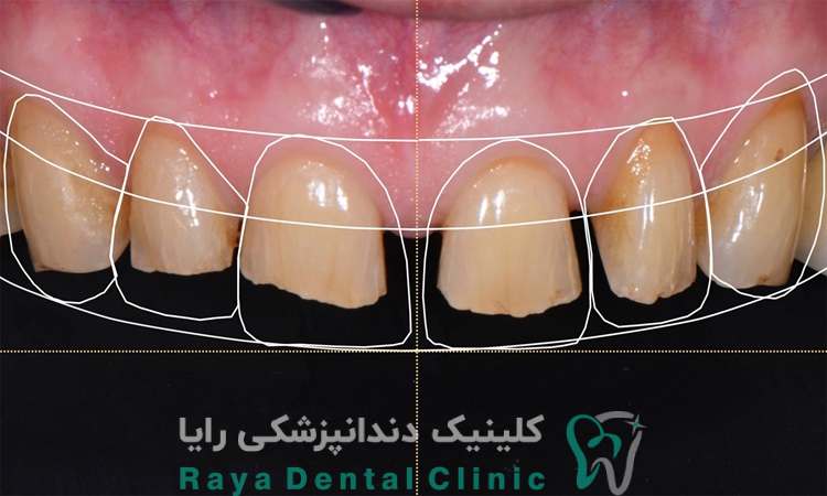 طراحی لبخند 