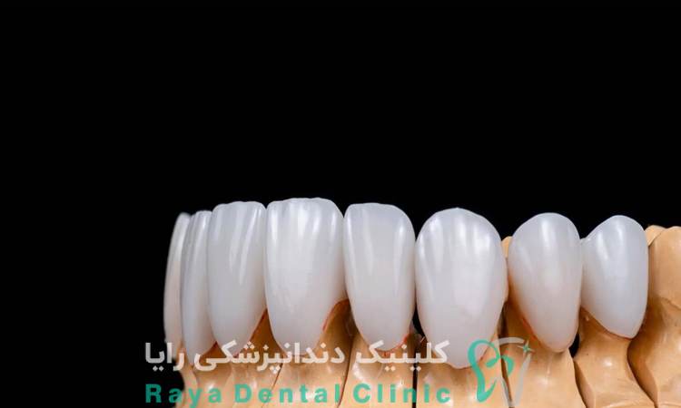 عمر لمینیت دندان