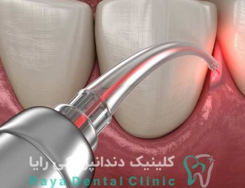 تفاوت ریکاوری بعد از ایمپلنت با لیزر و روش‌ های معمول