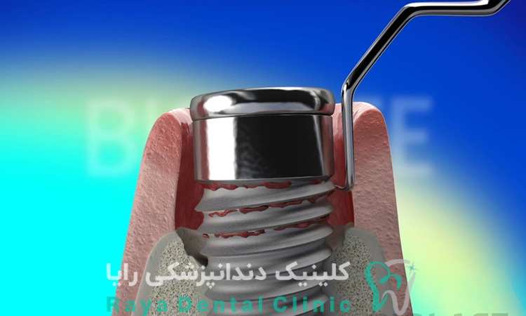 کاشت ایمپلنت دندان
