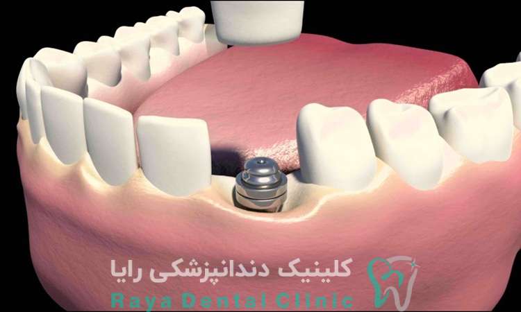 لیزر در ایمپلنت