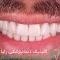 لمینت دندان