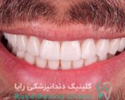 لمینت دندان
