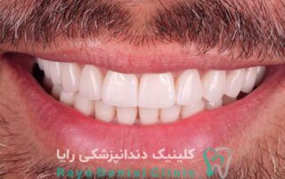 لمینت دندان