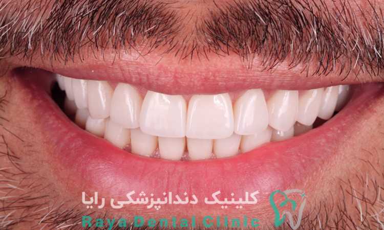 لمینت دندان