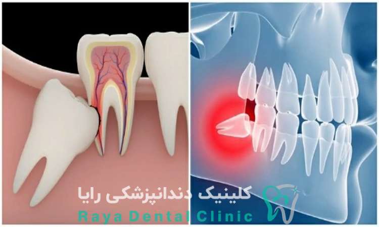 جراحی دندان عقل