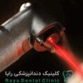 ایمپلنت با لیزر