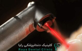 ایمپلنت با لیزر