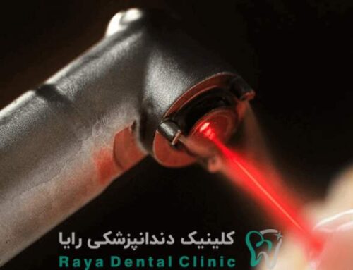 مزایا و معایب ریکاوری ایمپلنت با لیزر نسبت به سایر روش ها
