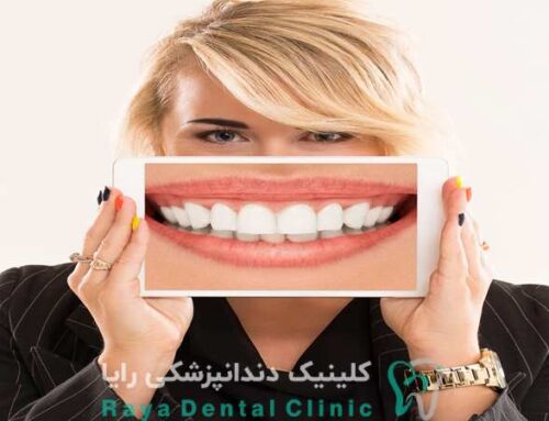 همه چیز درباره هزینه طراحی لبخند؛ چه عواملی بیشترین تاثیر را دارند؟