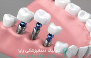 ایمپلنت فوری دندان