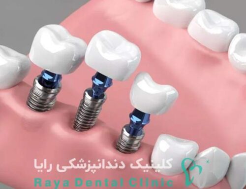 معرفی کلینیک‌ های معتبر برای ایمپلنت فوری دندان در تهران