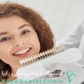 لمینیت فوری دندان