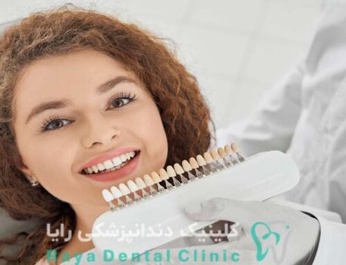 چرا لمینیت فوری دندان بین افراد مشهور محبوب است؟