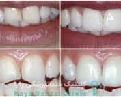 ترمیم دندان شکسته