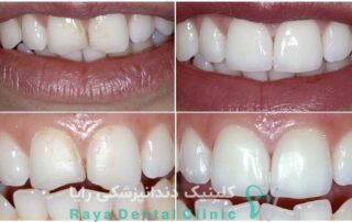 ترمیم دندان شکسته