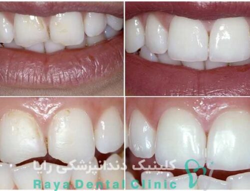 روش های مدرن ترمیم دندان شکسته با کامپوزیت