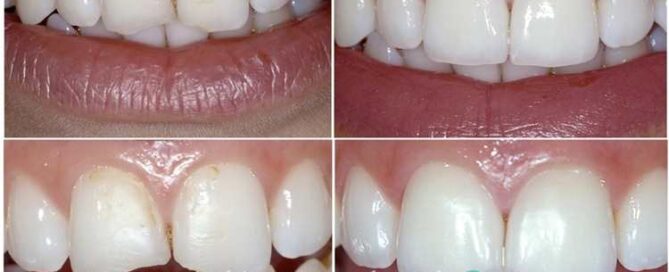 ترمیم دندان شکسته