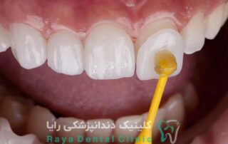 نقش ضخامت لمینیت