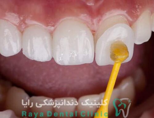 نقش ضخامت در دوام لمینیت بدون تراش دندان