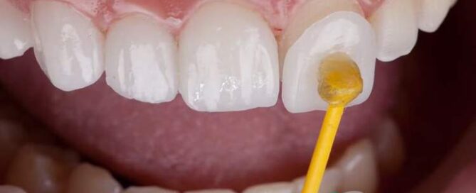 نقش ضخامت لمینیت