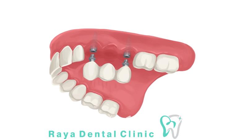 مرکز تخصصی برای فک ضعیف