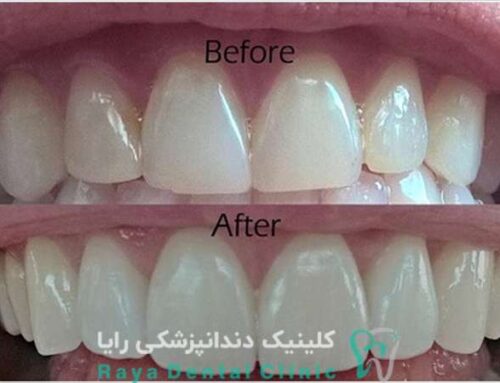 چرا برخی افراد به جای لمینت، کامپوزیت دندان را ترجیح می‌ دهند؟