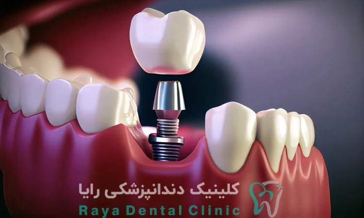 ایمپلنت فوری چیست؟