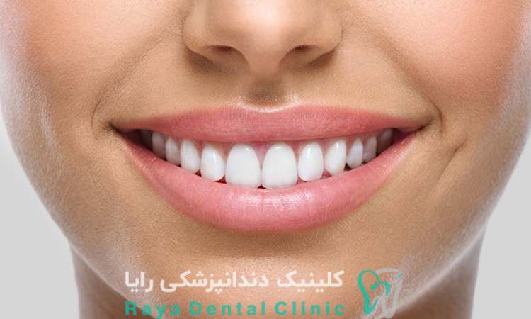 لمینت دندان