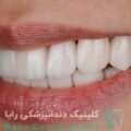 لمینیت فوری دندان