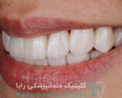 لمینیت فوری دندان