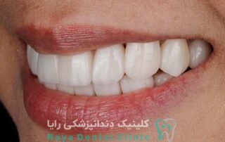 لمینیت فوری دندان