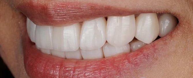 لمینیت فوری دندان