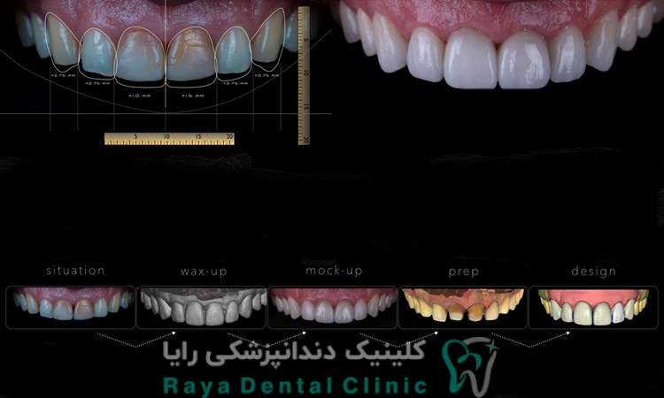 طراحی لبخند