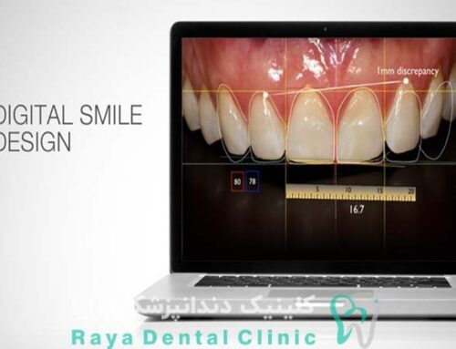 طراحی لبخند دیجیتال چیست و چرا دقت بالاتری دارد؟