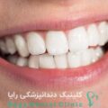 ماندگاری لمینیت دندان