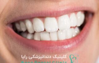 ماندگاری لمینیت دندان