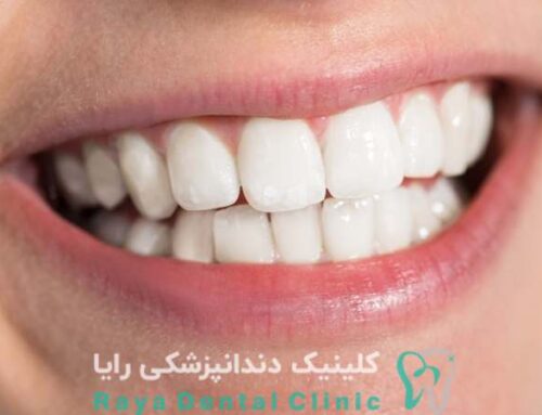 تاثیر سبک زندگی بر ماندگاری لمینیت دندان