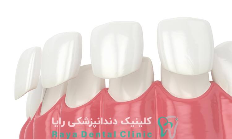 ثبات لمینت روی دندان