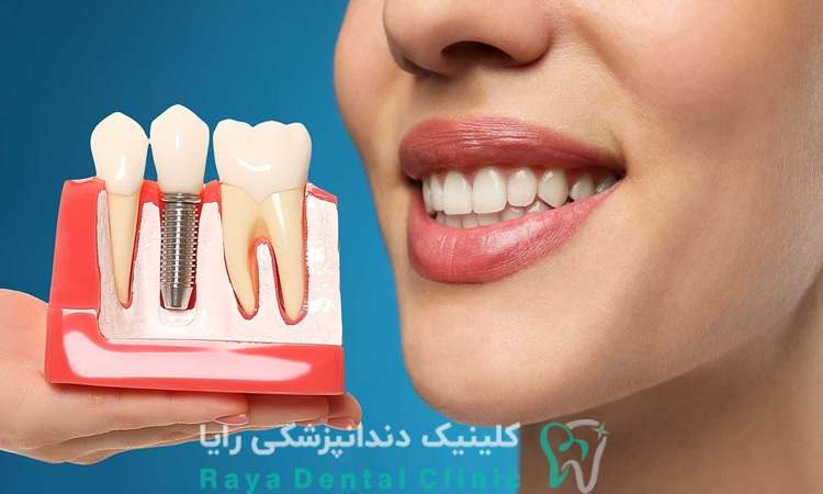 انتخاب نوع ایمپلنت